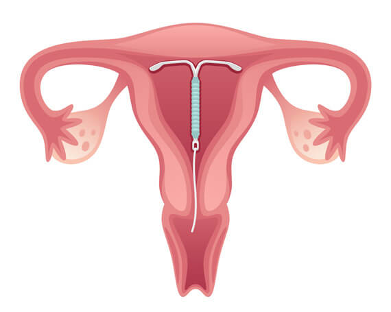 Aplicacion de dispositivo intrauterino. Barranquilla