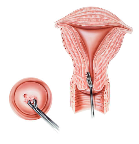 Biopsia endometrial en Barranquilla