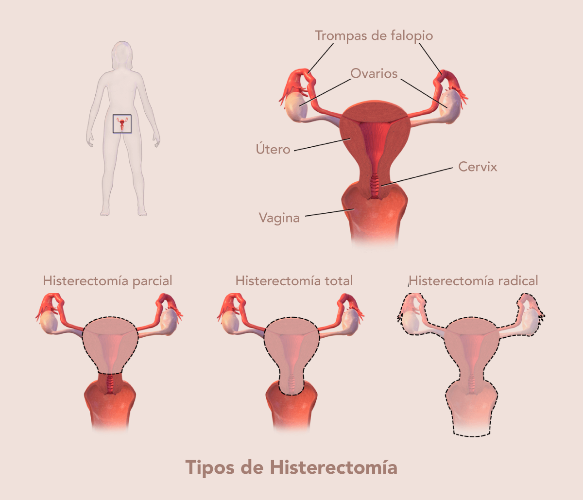 Histerectomia Barranquilla