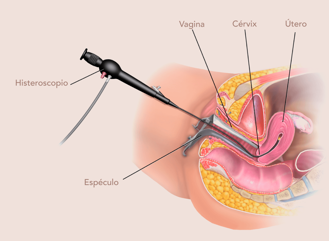 Histeroscopia diagnostica y operatoria Barranquilla