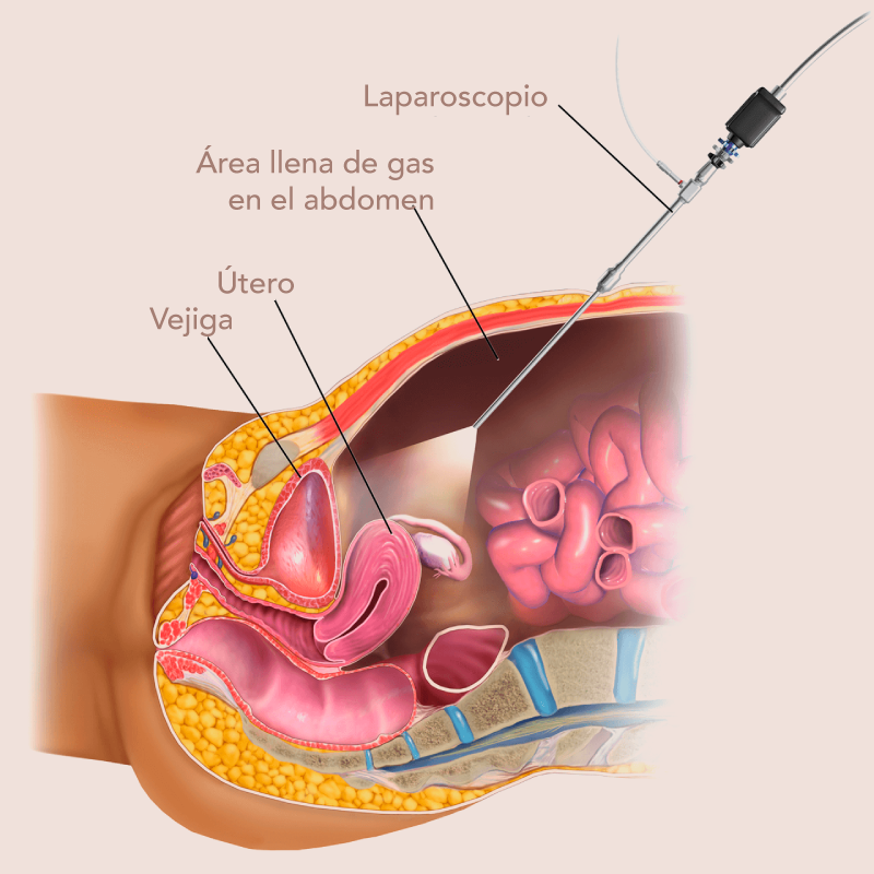 Laparoscopia ginecologica Barranquilla