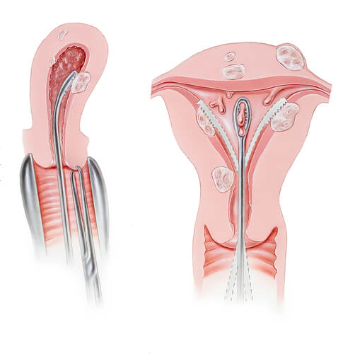 Legrado uterino Barranquilla